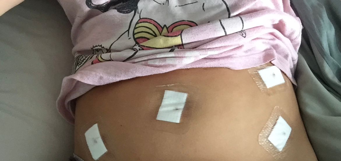Endometriosis diagnosis Endometriosis diagnosis